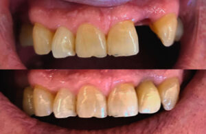 Lee más sobre el artículo La Travesía de un Implante Dental: De la Pérdida a una Sonrisa Completa